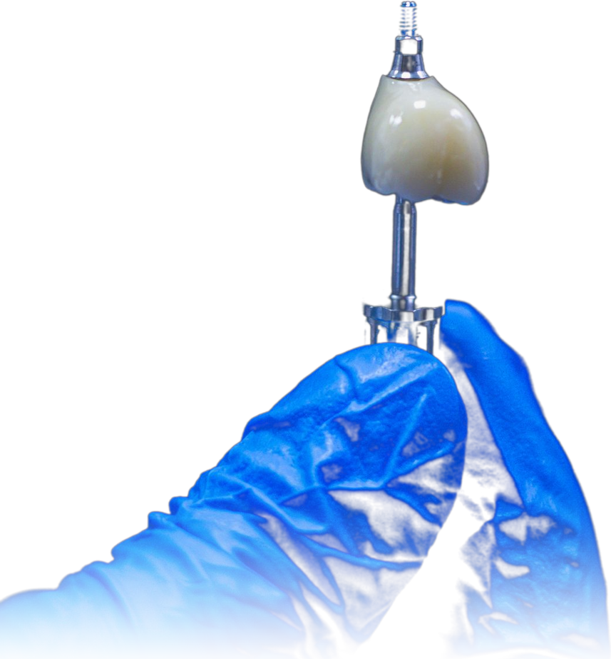 Kurorë mbi një implant dentar